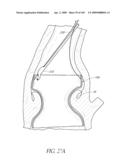 TRANSLUMENALLY IMPLANTABLE HEART VALVE WITH FORMED IN PLACE SUPPORT diagram and image