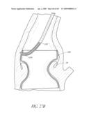 TRANSLUMENALLY IMPLANTABLE HEART VALVE WITH FORMED IN PLACE SUPPORT diagram and image