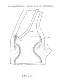 TRANSLUMENALLY IMPLANTABLE HEART VALVE WITH FORMED IN PLACE SUPPORT diagram and image