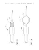 TRANSLUMENALLY IMPLANTABLE HEART VALVE WITH FORMED IN PLACE SUPPORT diagram and image