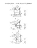 TRANSLUMENALLY IMPLANTABLE HEART VALVE WITH FORMED IN PLACE SUPPORT diagram and image