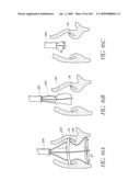 TRANSLUMENALLY IMPLANTABLE HEART VALVE WITH FORMED IN PLACE SUPPORT diagram and image