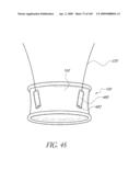 TRANSLUMENALLY IMPLANTABLE HEART VALVE WITH FORMED IN PLACE SUPPORT diagram and image