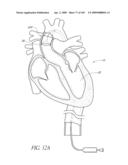 TRANSLUMENALLY IMPLANTABLE HEART VALVE WITH FORMED IN PLACE SUPPORT diagram and image