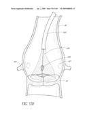 TRANSLUMENALLY IMPLANTABLE HEART VALVE WITH FORMED IN PLACE SUPPORT diagram and image