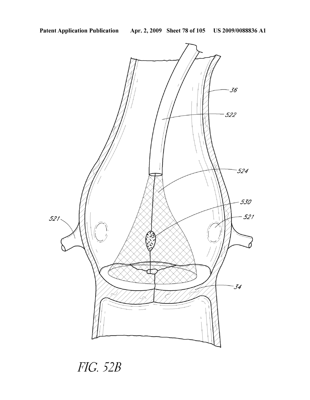 TRANSLUMENALLY IMPLANTABLE HEART VALVE WITH FORMED IN PLACE SUPPORT - diagram, schematic, and image 79