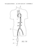 TRANSLUMENALLY IMPLANTABLE HEART VALVE WITH FORMED IN PLACE SUPPORT diagram and image