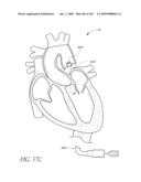 TRANSLUMENALLY IMPLANTABLE HEART VALVE WITH FORMED IN PLACE SUPPORT diagram and image