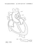 TRANSLUMENALLY IMPLANTABLE HEART VALVE WITH FORMED IN PLACE SUPPORT diagram and image