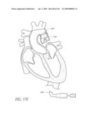 TRANSLUMENALLY IMPLANTABLE HEART VALVE WITH FORMED IN PLACE SUPPORT diagram and image