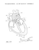 TRANSLUMENALLY IMPLANTABLE HEART VALVE WITH FORMED IN PLACE SUPPORT diagram and image