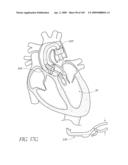 TRANSLUMENALLY IMPLANTABLE HEART VALVE WITH FORMED IN PLACE SUPPORT diagram and image