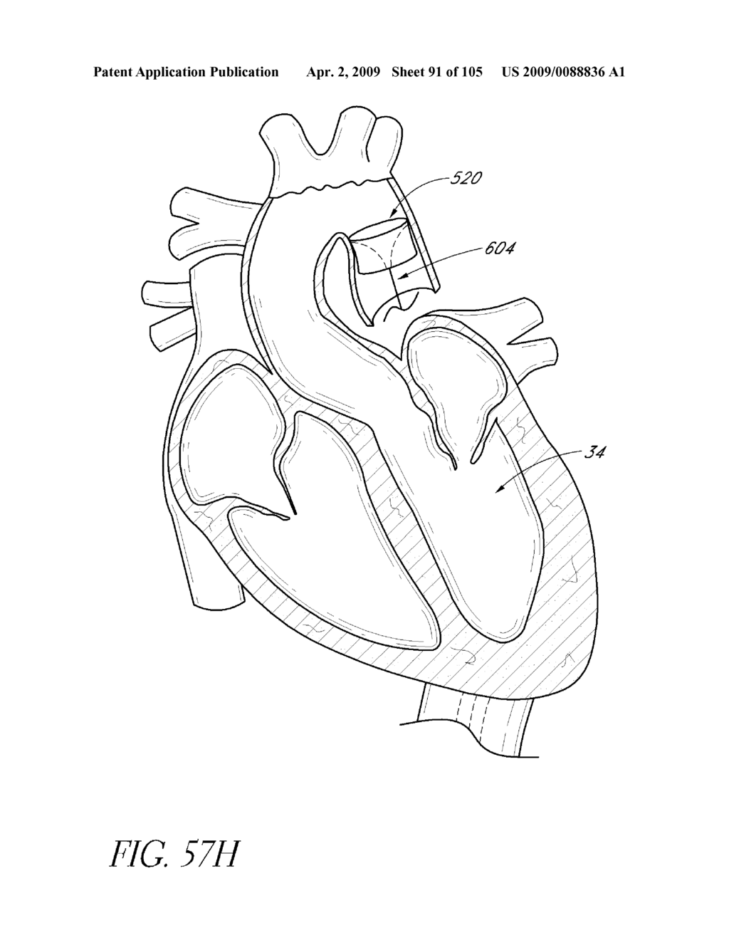 TRANSLUMENALLY IMPLANTABLE HEART VALVE WITH FORMED IN PLACE SUPPORT - diagram, schematic, and image 92