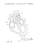 TRANSLUMENALLY IMPLANTABLE HEART VALVE WITH FORMED IN PLACE SUPPORT diagram and image