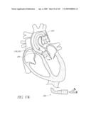 TRANSLUMENALLY IMPLANTABLE HEART VALVE WITH FORMED IN PLACE SUPPORT diagram and image