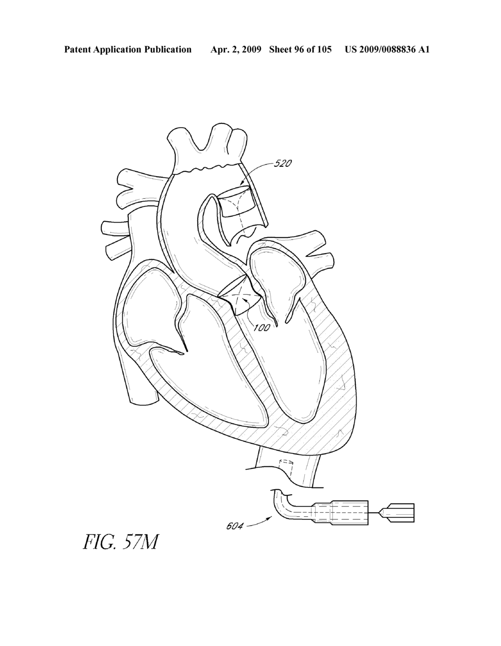 TRANSLUMENALLY IMPLANTABLE HEART VALVE WITH FORMED IN PLACE SUPPORT - diagram, schematic, and image 97