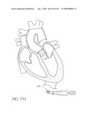 TRANSLUMENALLY IMPLANTABLE HEART VALVE WITH FORMED IN PLACE SUPPORT diagram and image