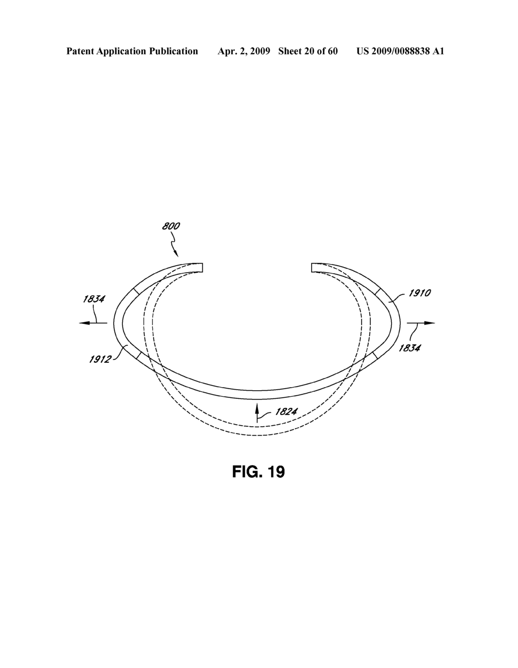 ADJUSTABLE ANNULOPLASTY RING AND ACTIVATION SYSTEM - diagram, schematic, and image 21