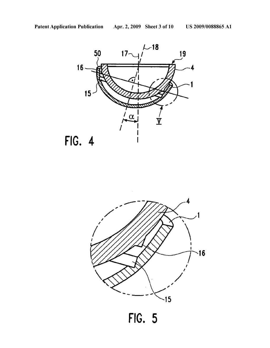 Modular Hip Implant - diagram, schematic, and image 04