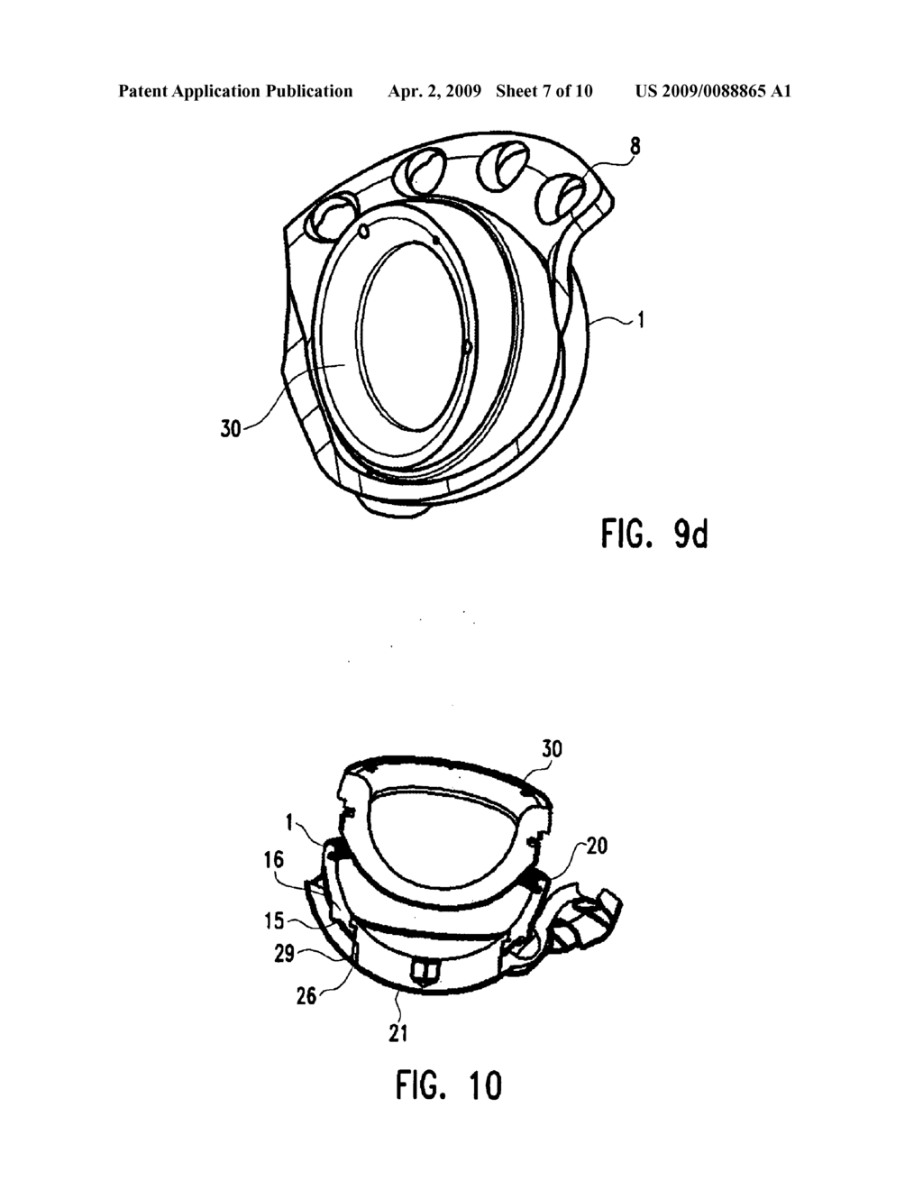 Modular Hip Implant - diagram, schematic, and image 08