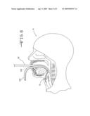 Guide device for tracheal intubation diagram and image