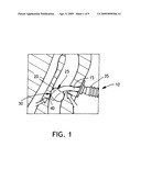 BALLOON CUFF TRACHEOSTOMY TUBE diagram and image