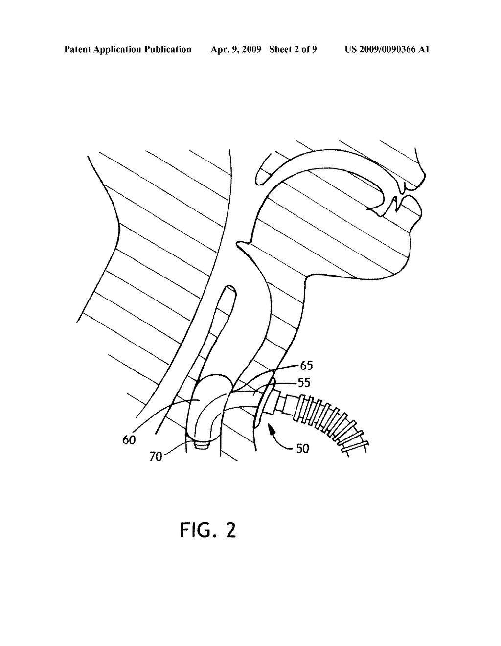 BALLOON CUFF TRACHEOSTOMY TUBE - diagram, schematic, and image 03