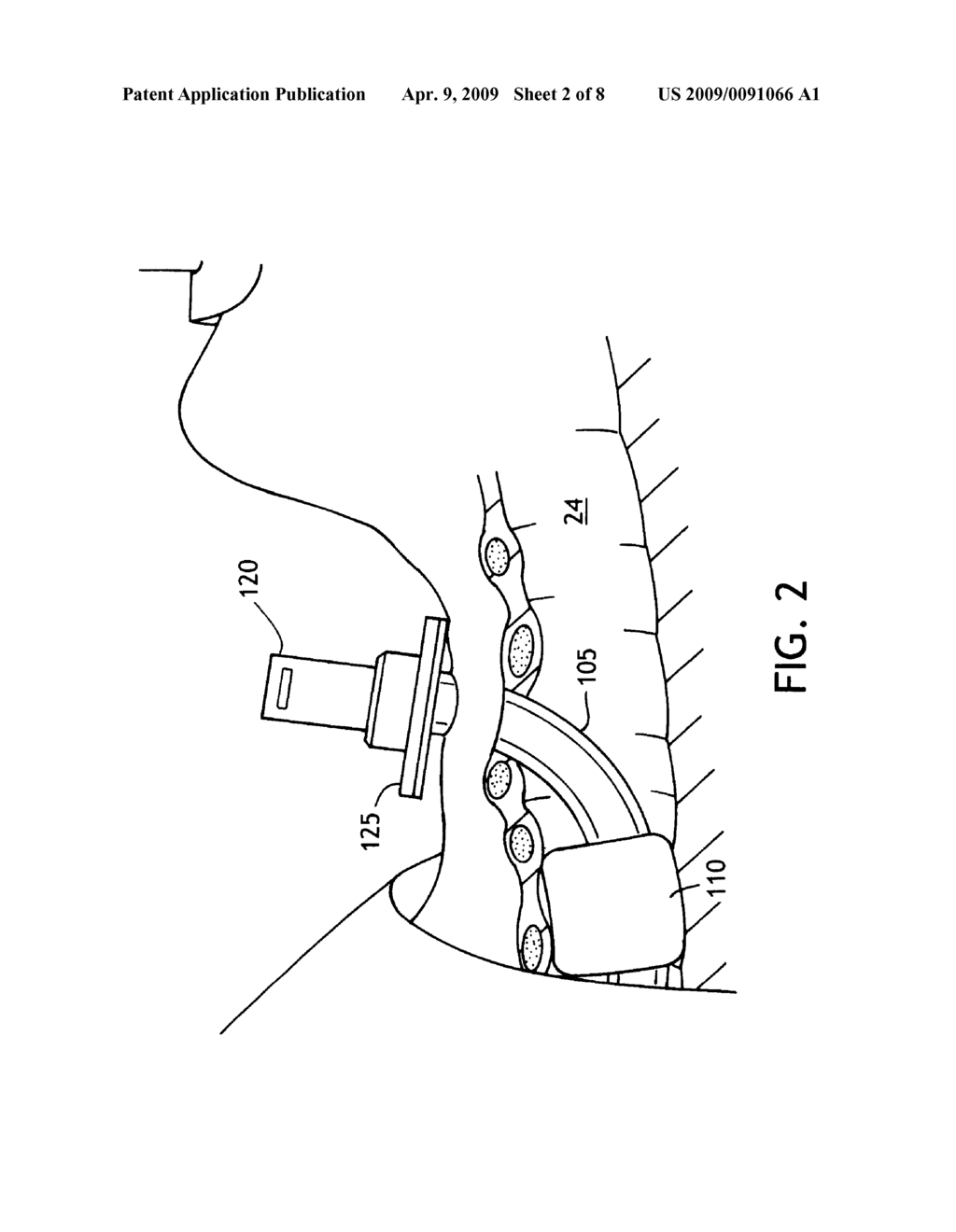 METHOD OF MAKING AN IMPROVED BALLOON CUFF TRACHEOSTOMY TUBE - diagram, schematic, and image 03