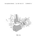 Energy Delivery and Microphone Placement Methods for Improved Comfort in an Open Canal Hearing Aid diagram and image