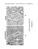 EARLY DIAGNOSIS AND TREATMENT OF DRUG RESISTANCE IN MUC1-POSITIVE CANCER diagram and image