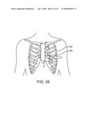 Treating Dysfunctional Cardiac Tissue diagram and image