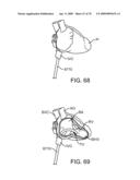 Treating Dysfunctional Cardiac Tissue diagram and image