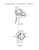 Treating Dysfunctional Cardiac Tissue diagram and image