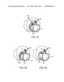 Treating Dysfunctional Cardiac Tissue diagram and image