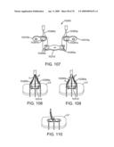 Treating Dysfunctional Cardiac Tissue diagram and image