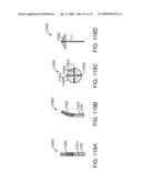 Treating Dysfunctional Cardiac Tissue diagram and image