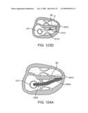 Treating Dysfunctional Cardiac Tissue diagram and image