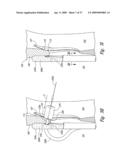 Systems and Methods for Transeptal Cardiac Procedures, Including Tissue Compression Devices and Methods diagram and image