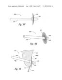 Systems and Methods for Transeptal Cardiac Procedures, Including Tissue Compression Devices and Methods diagram and image