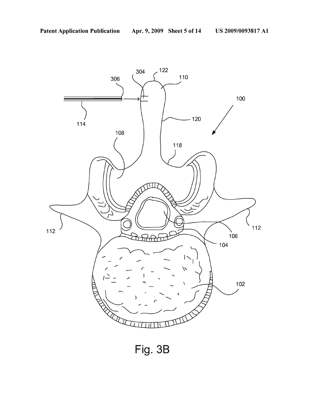 SYSTEMS AND METHODS FOR INJECTING BONE FILLER INTO THE SPINE - diagram, schematic, and image 06