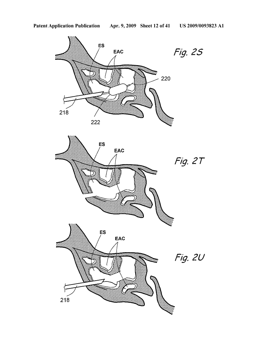 Devices, Systems and Methods Useable for Treating Sinusitis - diagram, schematic, and image 13