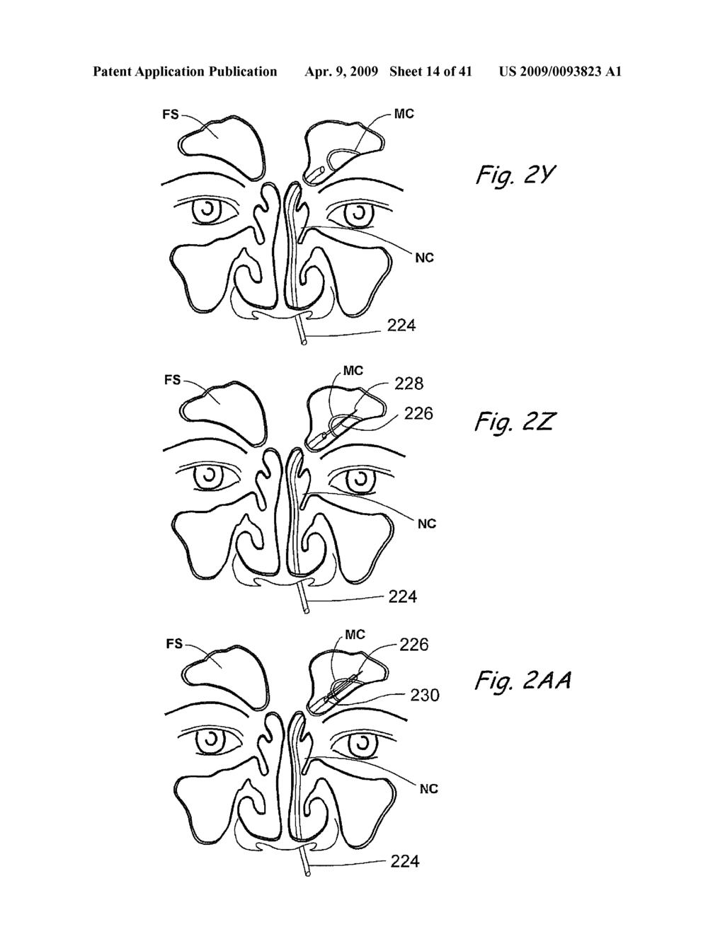 Devices, Systems and Methods Useable for Treating Sinusitis - diagram, schematic, and image 15