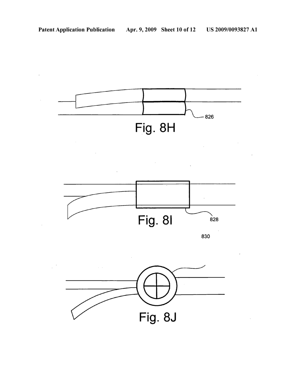 SUBCUTANEOUS WAIST BAND AND METHODS RELATED THERETO - diagram, schematic, and image 11