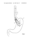 SHAPE MEMORY INTRAGASTRIC BALLOON diagram and image