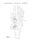 METATARSAL FIXATION SYSTEM diagram and image