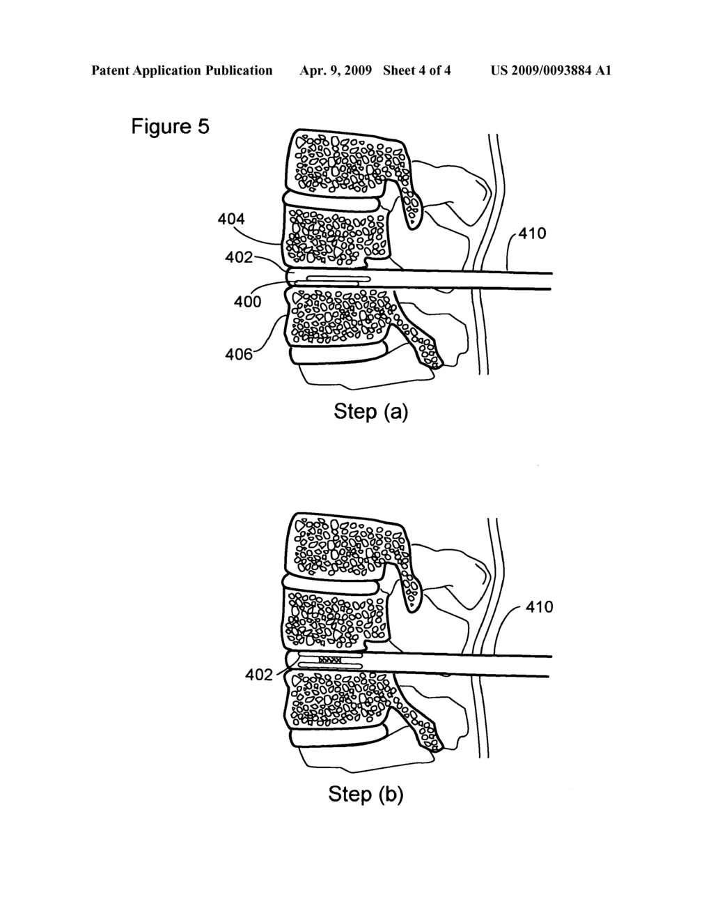 Prosthetic Intervertebral Discs Having Expandable Cores That Are Implantable Using Minimally Invasive Surgical Techniques - diagram, schematic, and image 05