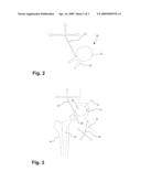 HIP REPLACEMENT IN COMPUTER-ASSISTED SURGERY diagram and image