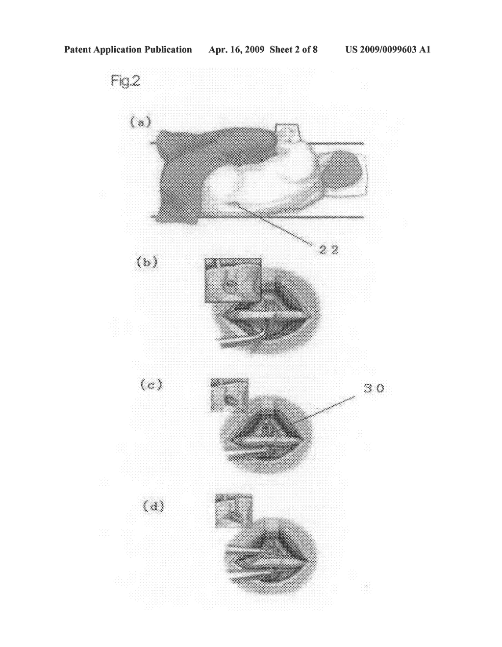 Minimally-Invasive Implant for Opening and Enlargement of Processus Spinosus Interspace and Method of Percutaneously Enlarging Processus Spinosus Interspace Therewith - diagram, schematic, and image 03