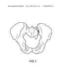METHODS OF STABILIZING THE SACROILIAC JOINT diagram and image