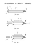 METHODS OF STABILIZING THE SACROILIAC JOINT diagram and image